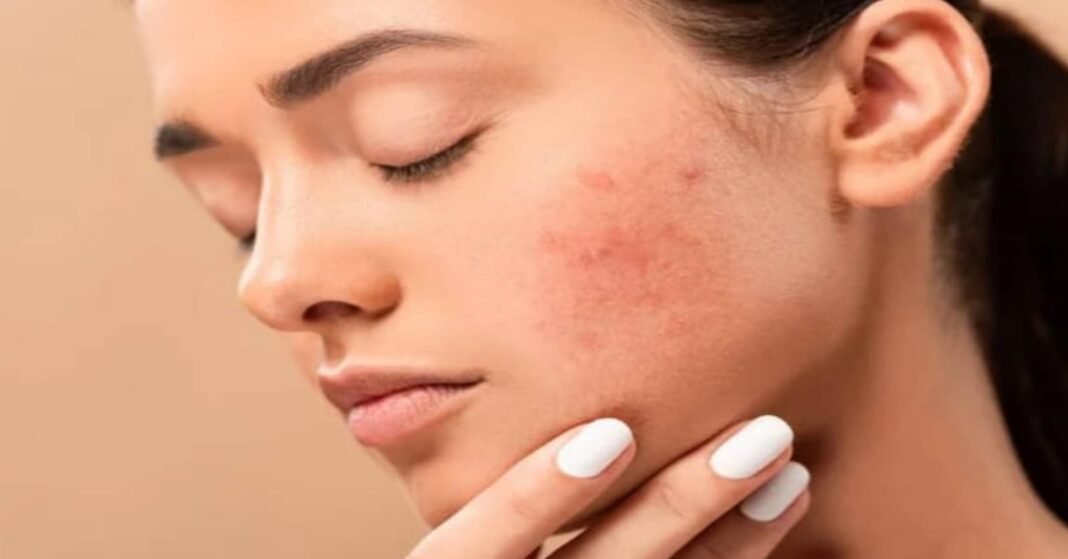 acne, face mapping
