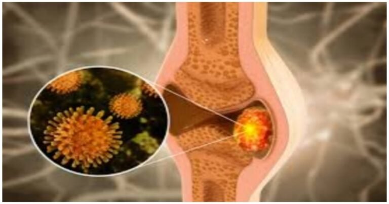 Bone cancer