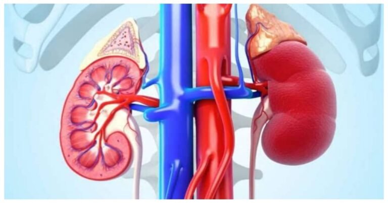 Kidney-failure