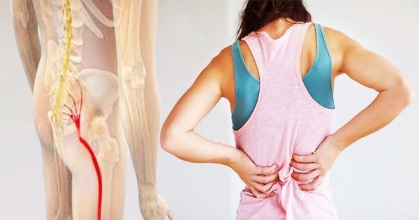 Sciatica