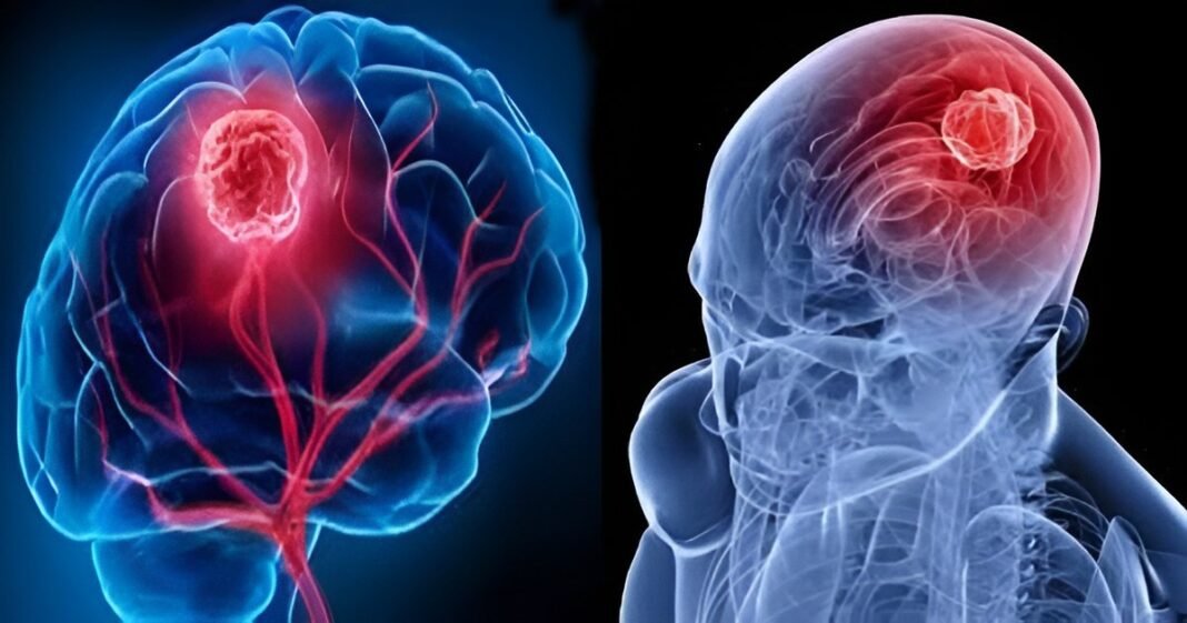 brain tumor
