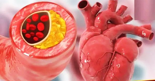 Heart Blockage