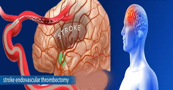brain stroke