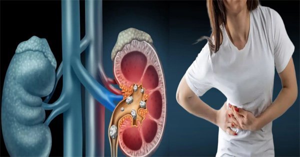 Kidney