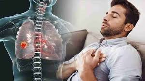 lung cancer 1