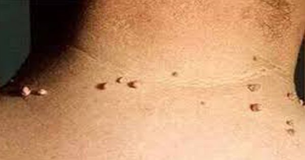warts