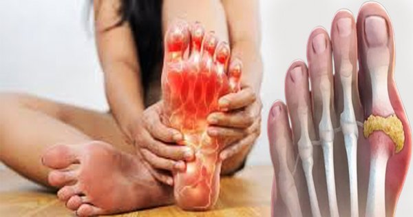Uric Acid