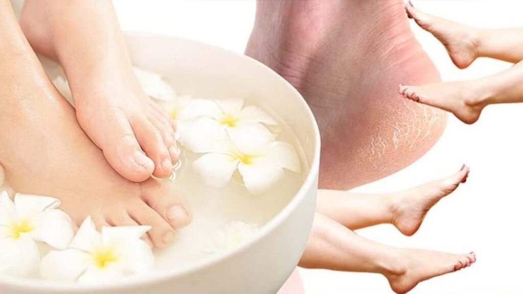 winter cracked heels easy remedies 1