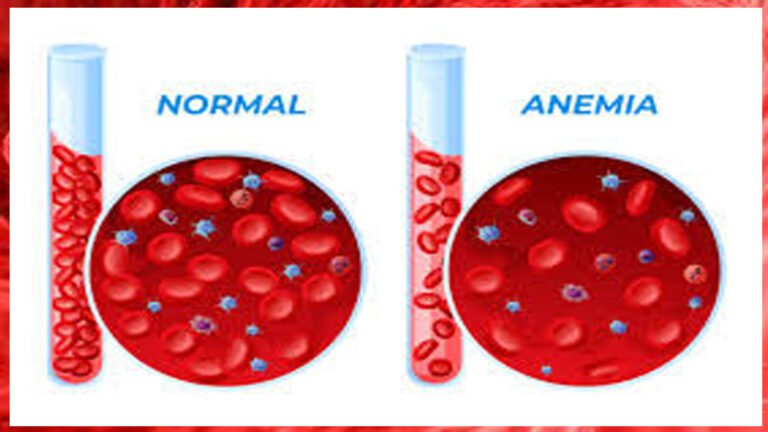ರಕ್ತಹೀನತೆಯೇ? 15 ದಿನಗಳಲ್ಲಿ ಪರಿಹಾರ ಕಾಣಬಹುದಾದ ಸರಳ ಮನೆಮದ್ದು!