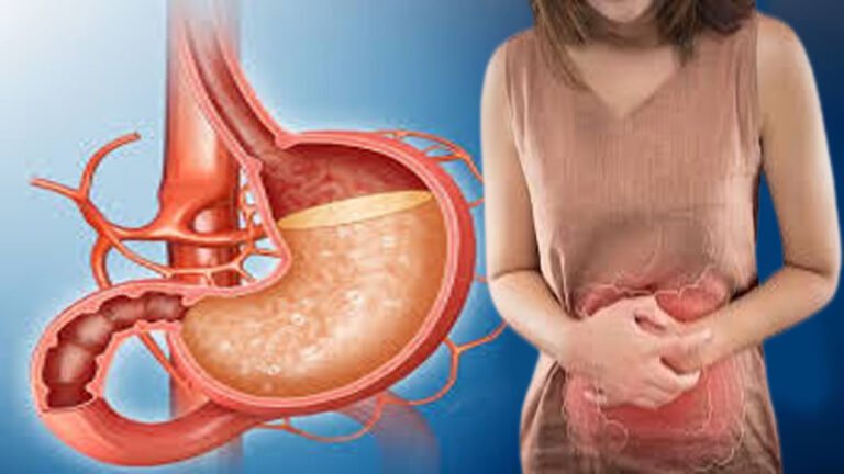 ಹೊಟ್ಟೆ ಉಬ್ಬರ, ಎದೆಉರಿ ಸಮಸ್ಯೆಯೇ? ಗ್ಯಾಸ್ಟ್ರಿಕ್‌ ಸಮಸ್ಯೆಗೆ ಸರಳ ಉಪಾಯಗಳು.